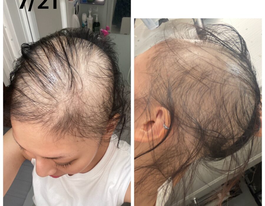 【コロナ】モデルナのワクチンを接種後に髪の毛が抜けてしまった女性が現れる